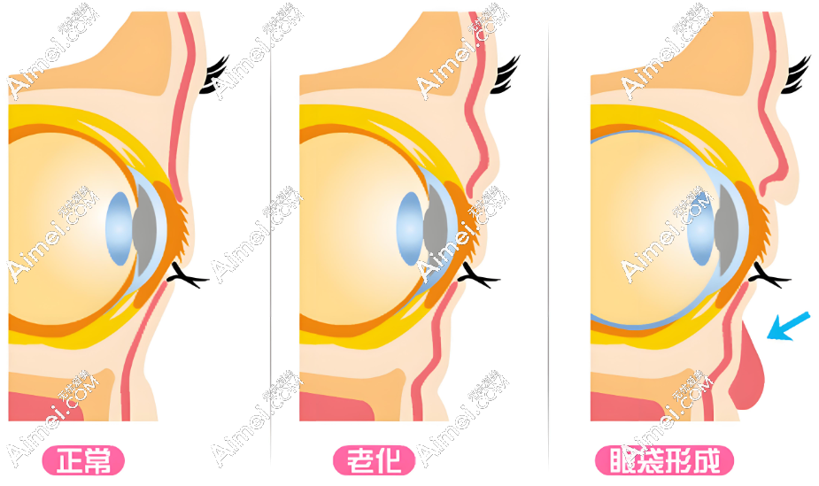 眼袋形成过程 眼袋形成过程