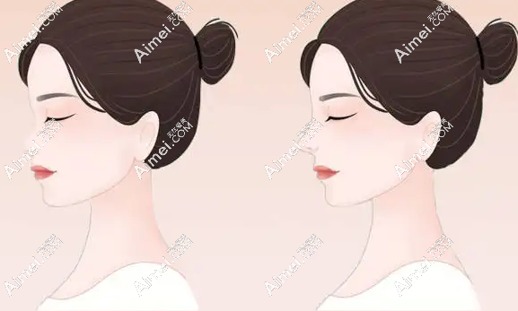 成都齐丙迪做鼻子好吗?从齐丙迪真人鼻综合实例来看他做鼻子真的好看 成都齐丙迪做鼻子好吗?从齐丙迪真人鼻综合实例来看他做鼻子真的好看