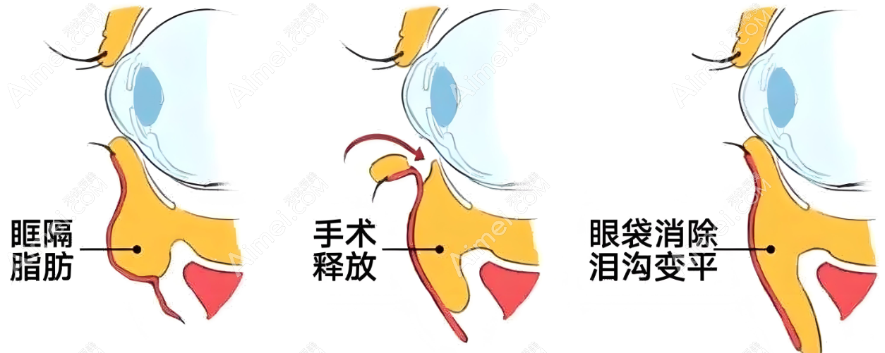 深圳朱冠峰祛眼袋手术www.dlren.com 深圳朱冠峰祛眼袋手术www.dlren.com