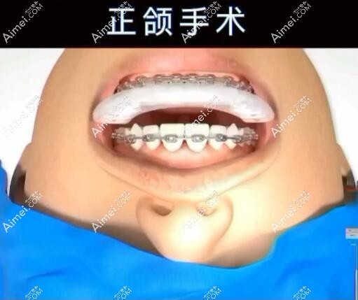 王涛医生做正颌手术怎么样?技术优势 王涛医生做正颌手术怎么样?技术优势