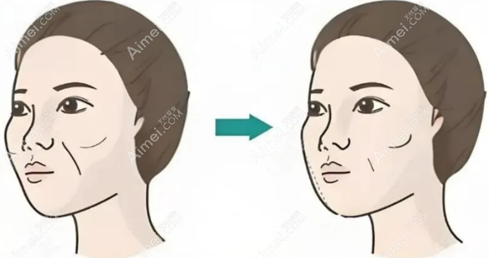 馒化脸 馒化脸