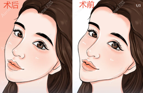 维密金雕面部前后对比照片图 维密金雕面部前后对比照片图