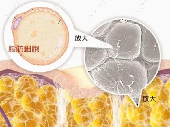 脂肪医生韦元强做自体脂肪丰胸失败结节取出修复好,技艺高超,信赖之选! 脂肪医生韦元强做自体脂肪丰胸失败结节取出修复好,技艺高超,信赖之选!