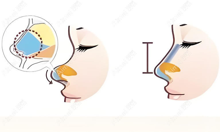 徐利刚肋骨鼻失败实例有吗 徐利刚肋骨鼻失败实例有吗