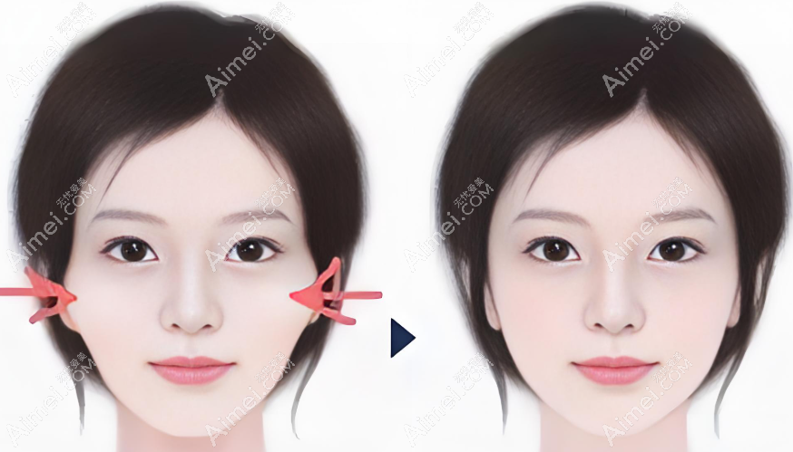 一针降颧骨www.dlren.com 一针降颧骨www.dlren.com