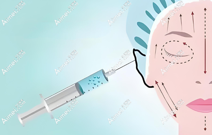 注射微整提拉改善 注射微整提拉改善