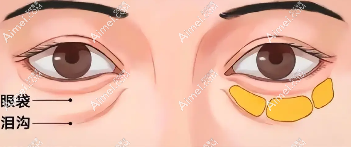 郑州贺洁修复眼袋靠谱!从真实事例来看贺洁做眼袋修复、卧蚕修复真的可靠,口碑爆好！