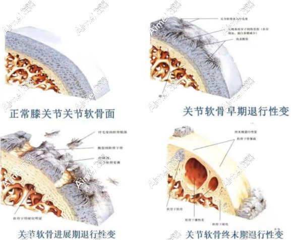 骨性膝关节炎能治好吗？能，(可特立)细胞疗法从根本上治疗膝关节炎