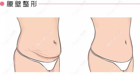 北京腹壁成型技术好的医院排名:嘉禾/蒂凡妮/华韩等上榜北京腹壁整形top4(均价40000+)
