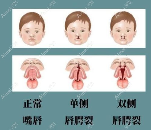 国内唇腭裂二期修复好的医院排名前十,兔唇二期修复好的医院分布在广州/重庆/南京/成都!