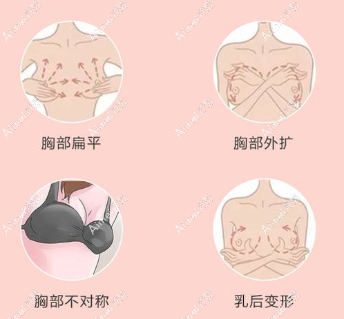 北京隆胸医院可以改善胸型dlren.com