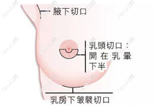 乳房下皱襞切口