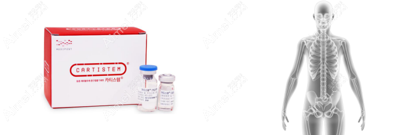 cartistem可特立治疗膝关节软骨磨损的成效好!术后疼痛感减轻,手术风险小