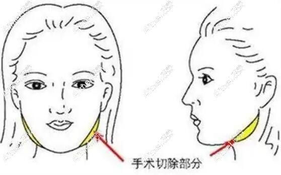 付国友磨骨怎么样?付国友在武汉中翰整形医院做下颌角磨骨及失败修复技术好