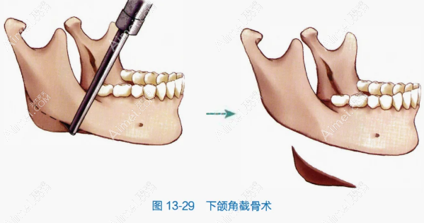 重庆下颌角截骨医生排名榜出炉：肖林/朱乐林/吴一等医生荣登榜单，信赖之选！