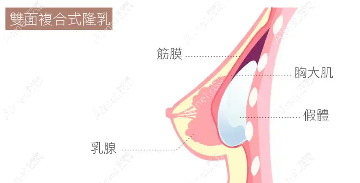 隆胸手术示意图 隆胸手术示意图