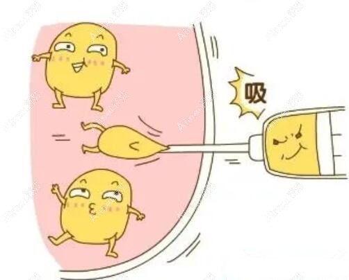 成都王欣吸脂怎么样?王欣做魔塑面吸/威塑体雕等吸脂手术水平高,口碑好受欢迎!