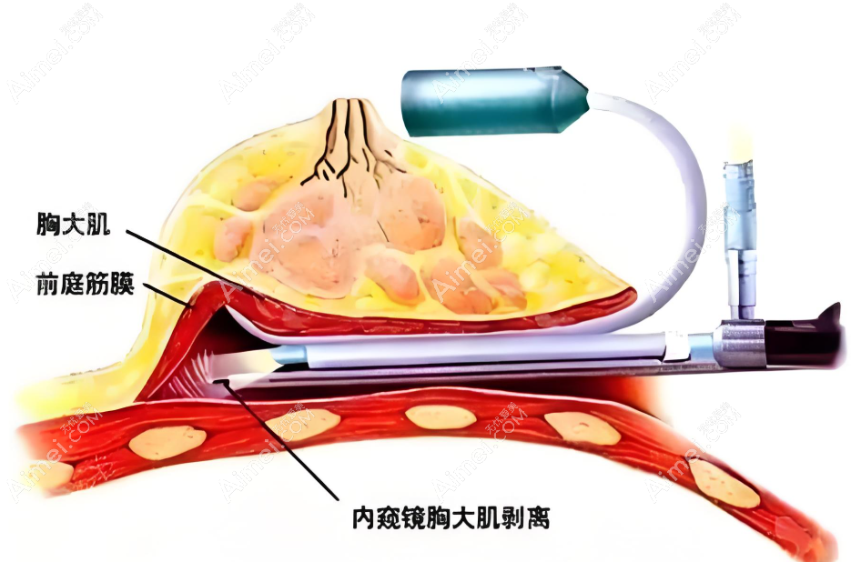 成都米兰柏羽隆胸真的使用内窥镜 成都米兰柏羽隆胸真的使用内窥镜