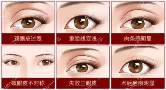 上海眼修复王衡健和杜园园哪个好？都好，王衡健侧重双眼皮修复/杜园园侧重眼角修复