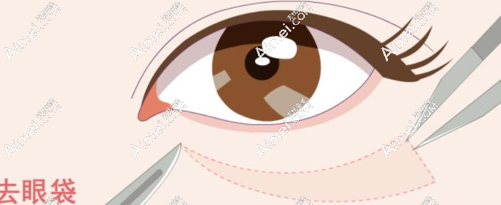 西安傲丽医疗美容医院徐佳明简介:不开刀去眼袋超火!实践测评后真觉得...