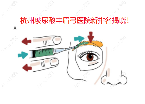 杭州玻尿酸丰眉弓医院新排名揭晓！年度精选玻尿酸注射榜单公开top5机构，2025版