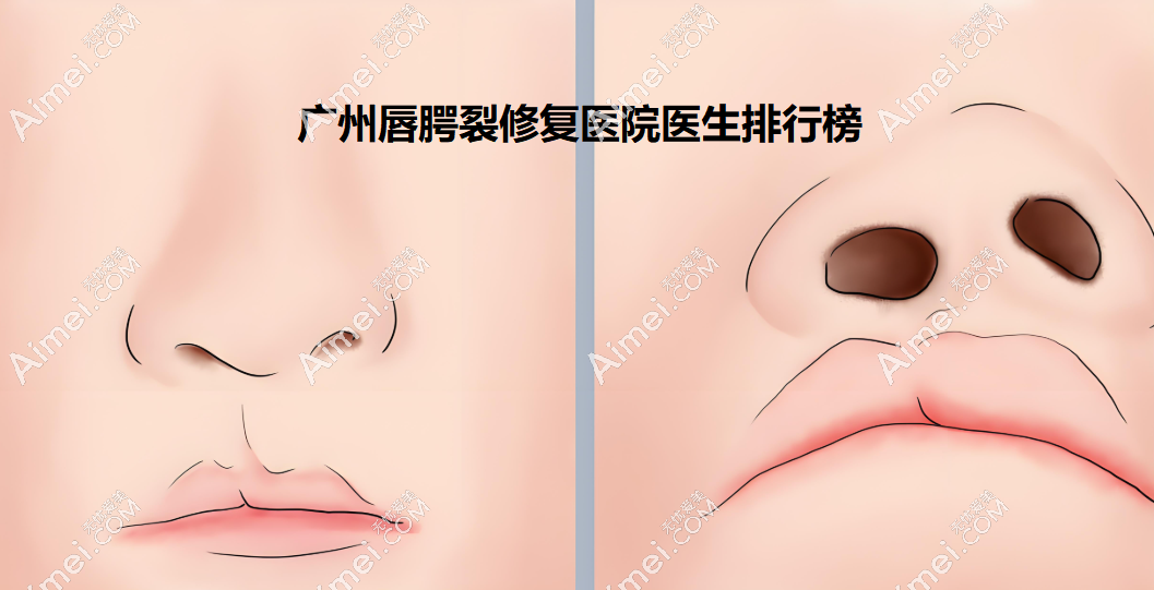 2025年广州唇腭裂修复医院医生排名榜帮你轻松避坑!“神仙医生”技术超棒