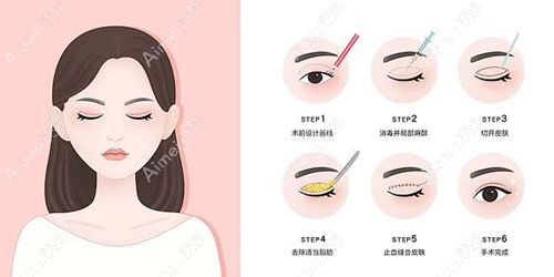 张莹莹个人简历与成就汇总，张莹莹50多岁了做双眼皮医术好，鲜有失败实例