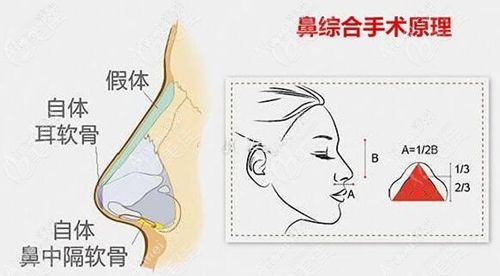 沃尔冯雁平隆鼻口碑如何 沃尔冯雁平隆鼻口碑如何