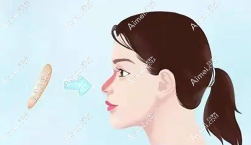 我的7万肋骨膨体鼻综合经历 我的7万肋骨膨体鼻综合经历
