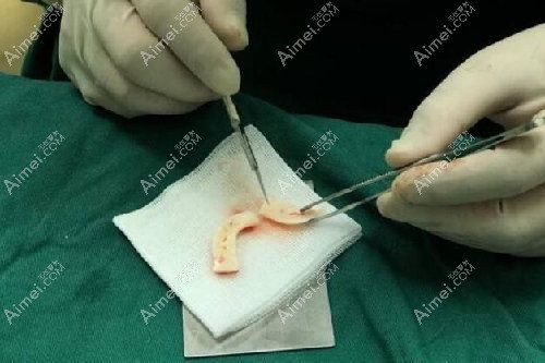 李保锴做鼻子怎么那么贵 李保锴做鼻子怎么那么贵