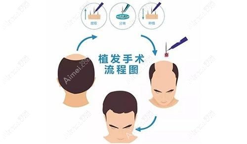 碧莲盛不剃发植发实例 碧莲盛不剃发植发实例