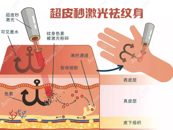 2025深圳洗纹身好的医院排名榜,推荐鹏程、美莱等做皮秒激光洗纹身好的正规医院