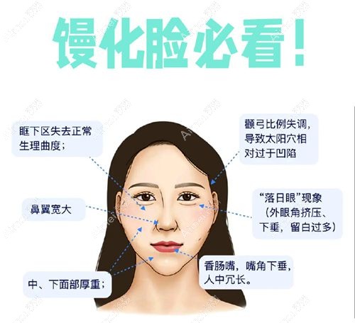 成都朱慧东馒化修复做得好，从发泡馒化脸到轻薄小v脸改善明显，这实例谁看了不说绝？