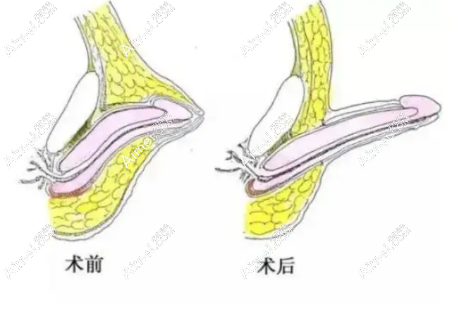 李世荣男性生殖整形实例