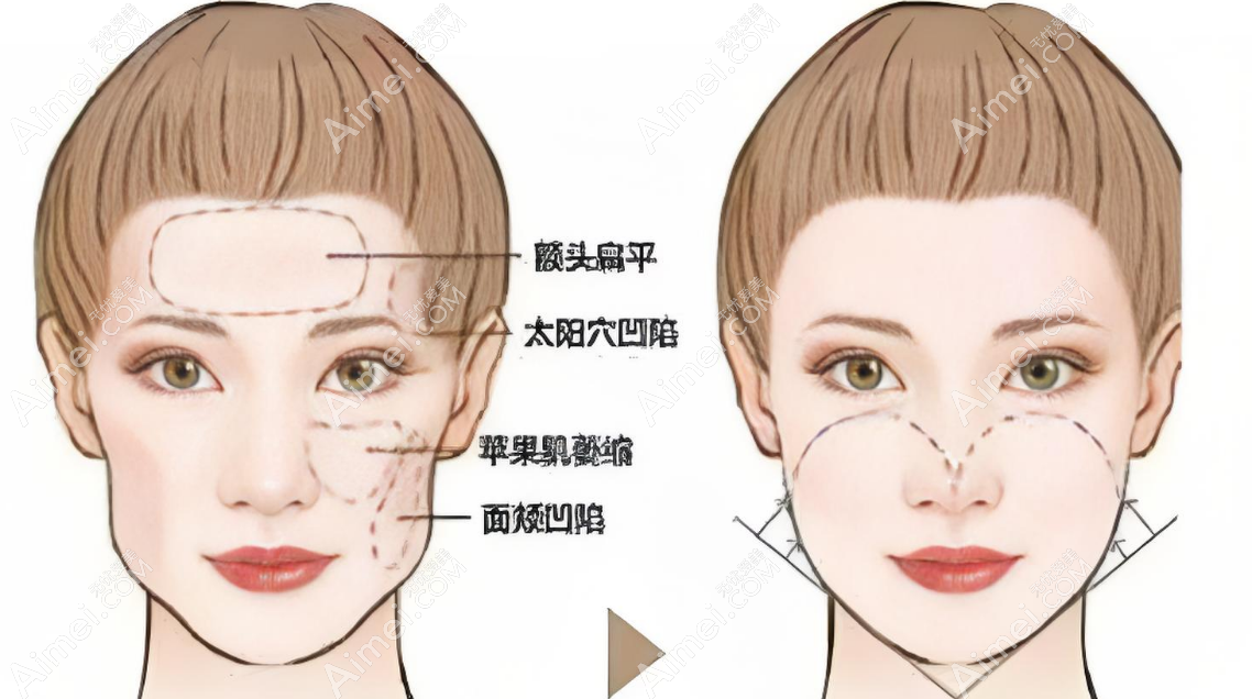 王明利脂肪填充对比 王明利脂肪填充对比
