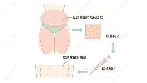 王明利的个人资料曝光，他是正规医院医生做脂肪填充靠谱很少有失败