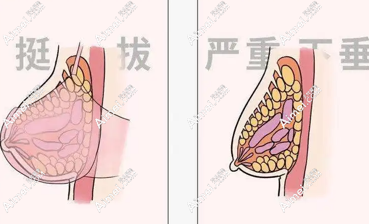 2025胸部韧带提升术价格揭秘:成都/上海/杭州价差3倍,轻度下垂5千起,重度胸部韧带提升5万起