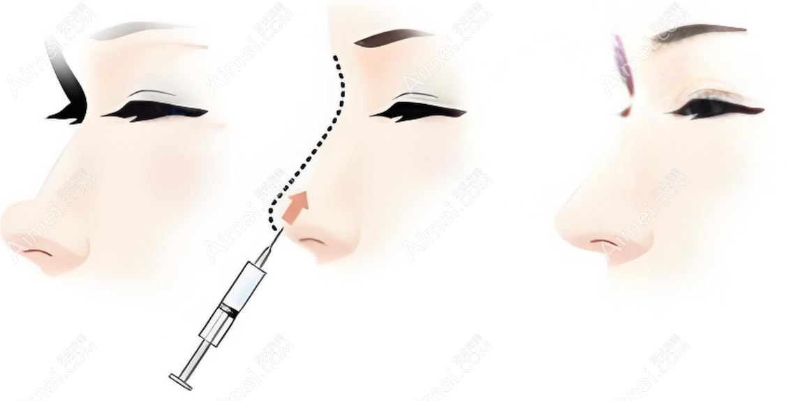 注射隆鼻有哪几种材料 注射隆鼻有哪几种材料