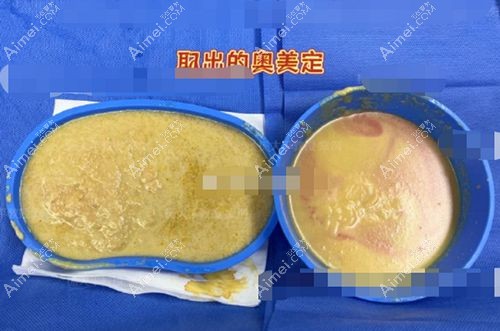 上海华美奥美定取出为何能实现"干净无残留" 上海华美奥美定取出为何能实现"干净无残留"