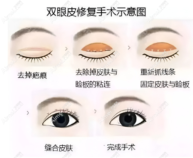 北京张冰洁修复双眼皮怎么样 北京张冰洁修复双眼皮怎么样