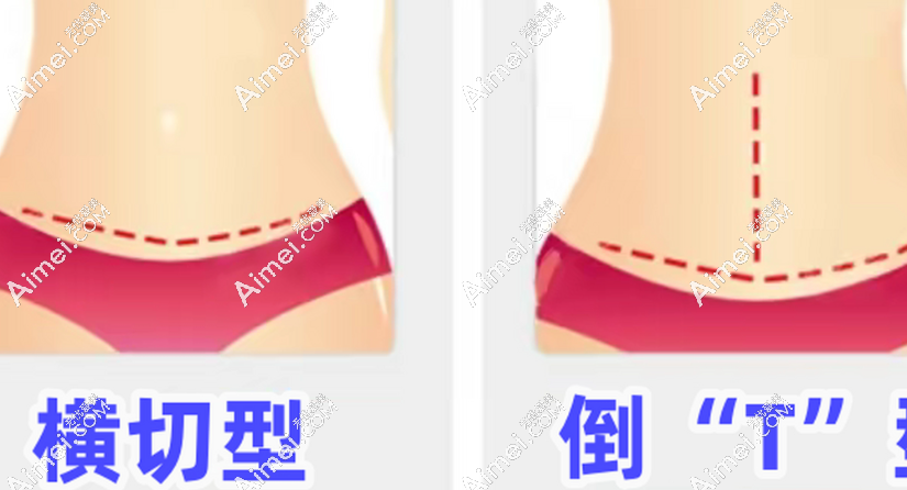 崔鑫医生做腹壁整形技术硬核 崔鑫医生做腹壁整形技术硬核