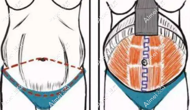崔鑫医生个人简历:做腹壁整形和隆胸技术靠谱 崔鑫医生个人简历:做腹壁整形和隆胸技术靠谱