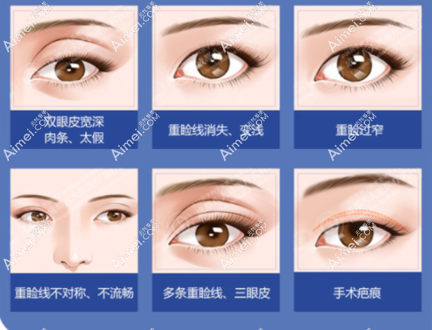 北京双眼皮修复价格便宜的医生是谁 北京双眼皮修复价格便宜的医生是谁