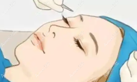 北京常冬青修复双眼皮技术优势 北京常冬青修复双眼皮技术优势