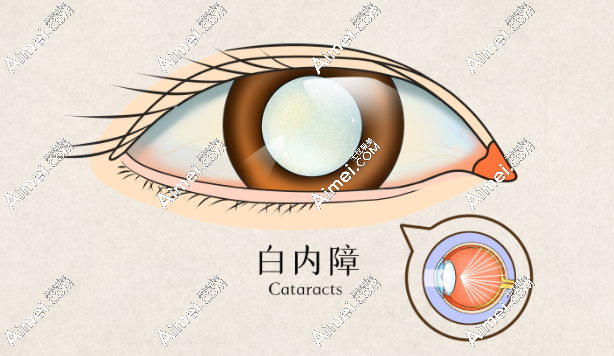 保定鹰华眼科医院叶子隆医生怎么样 保定鹰华眼科医院叶子隆医生怎么样