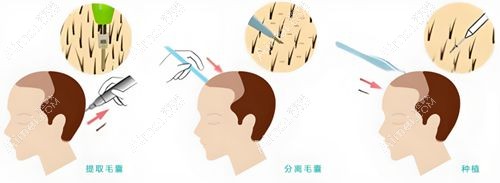 男士发际线种植国内植发医院价格对比 男士发际线种植国内植发医院价格对比