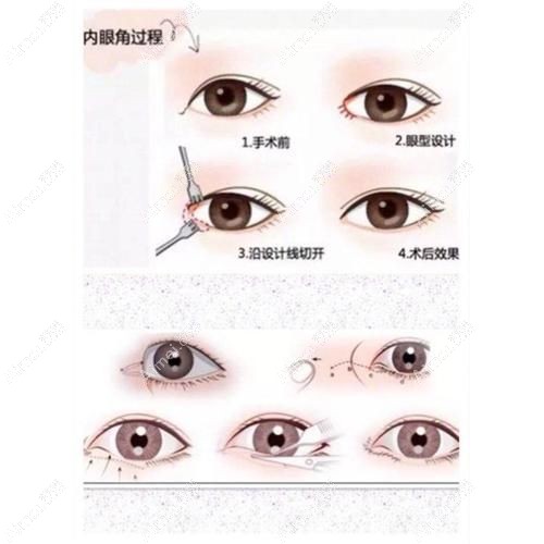 魏志香和张冰洁内眼角修复口碑真实反馈 魏志香和张冰洁内眼角修复口碑真实反馈
