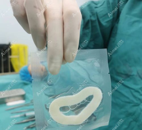 5d 生物束带紧缩术深度测评 5d 生物束带紧缩术深度测评