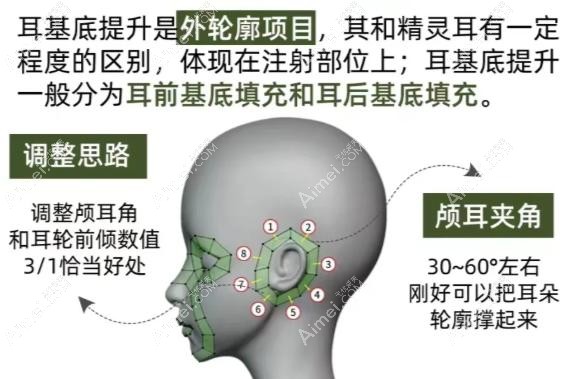 耳基底提升打什么牌子的玻尿酸好