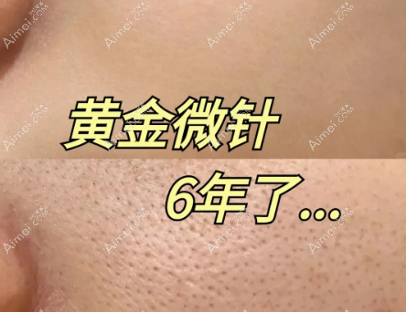 黄金微针 黄金微针